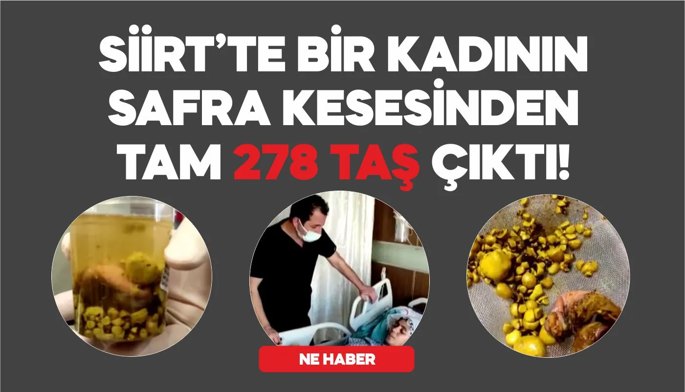 56 YAŞINDAKİ KADININ SAFRA KESESİNDE 278 TAŞ ÇIKARILDI