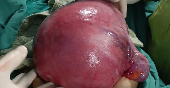 Siirt’te 40 Yaşındaki Hastadan 2.600 Gram Ağırlığında Myom Çıkarıldı
