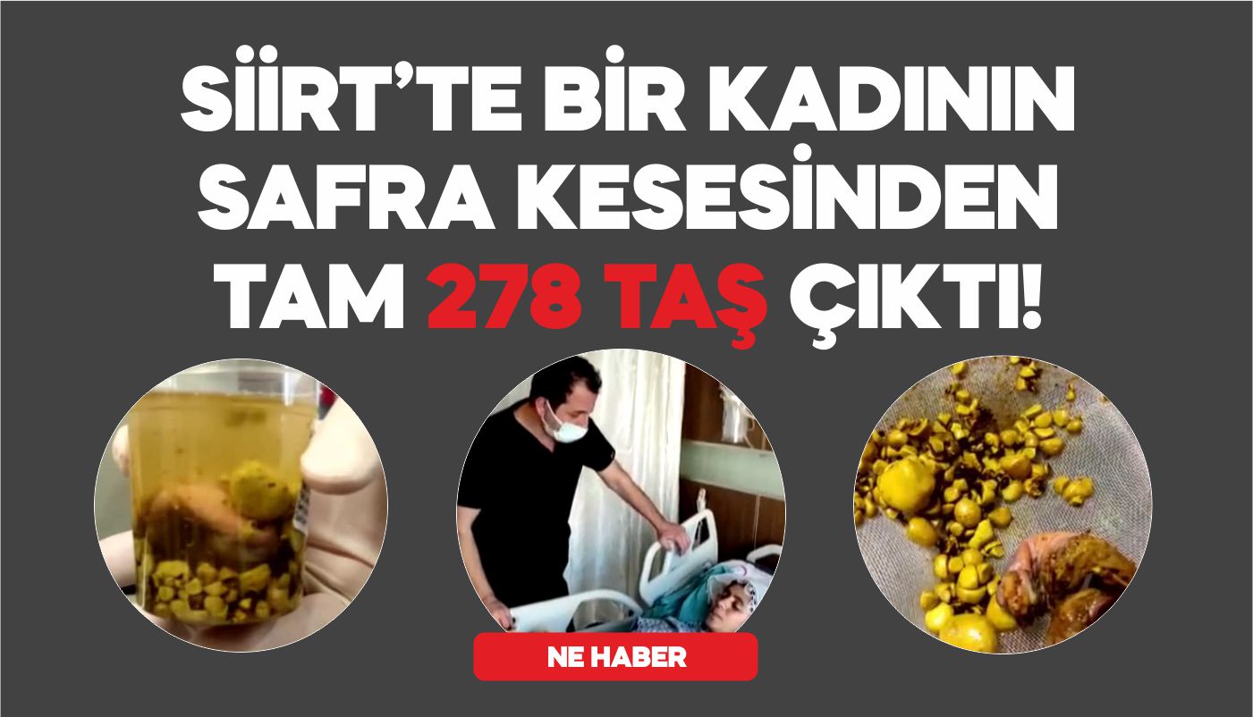 56 YAŞINDAKİ KADININ SAFRA KESESİNDE 278 TAŞ ÇIKARILDI