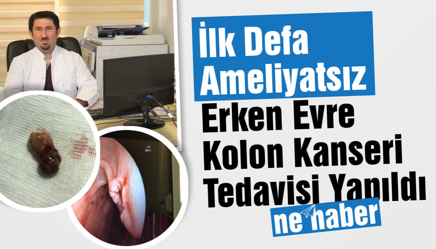 İLK DEFA AMELİYATSIZ ERKEN EVRE KOLON KANSERİ TEDAVİSİ YAPILDI